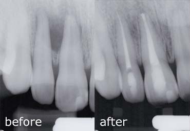 Before and after treatment with bridges